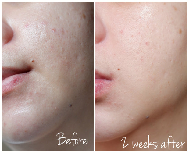 [Pyunkang yul] Acne Cream